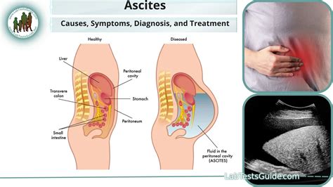 Understanding Ascites: Causes, Symptoms, and Effective Treatments Explained