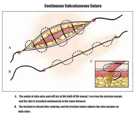 What Are Continuous Sutures Used For