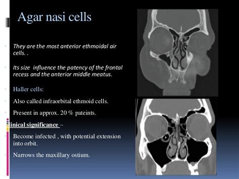 what are haller cells sinus