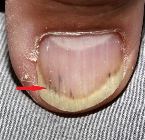 What Are Nail Splinters