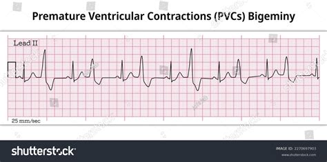 Understanding Heart Health: What Are PVCs and How Do They Affect Your Body
