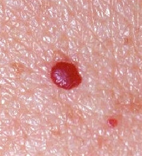 what are red skin moles