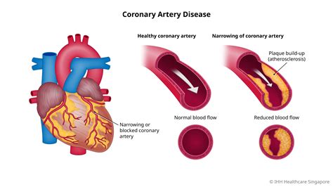 what are the 4 stages of coronary artery disease
