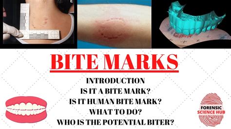 What Are The 7 Types Of Bite Marks