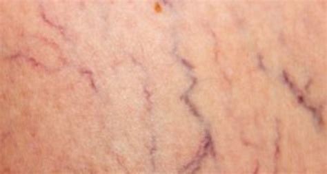 what are the purple lines on my legs