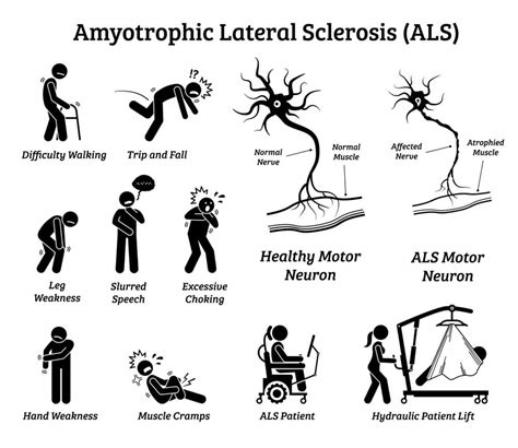 what are the symptoms of als disease