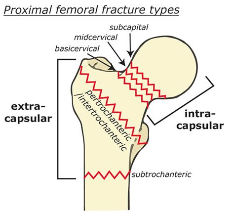 what are the types of fracture femur