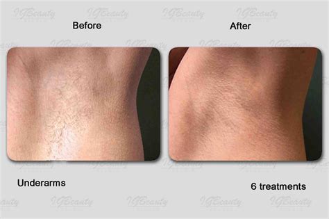 what area is brazilian laser hair removal