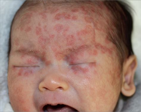 what can i put on my newborn's face rash