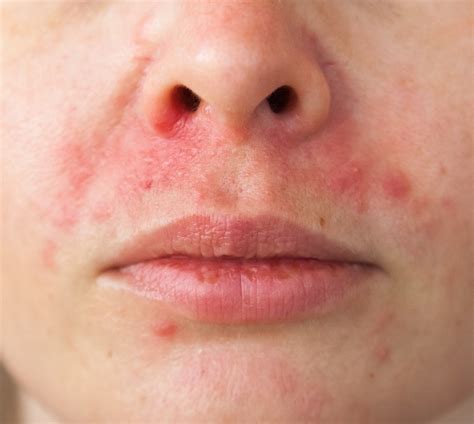 what can i use on my face for dermatitis
