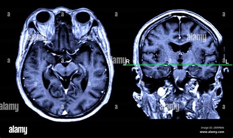 What Can Mri Scans Detect In The Brain