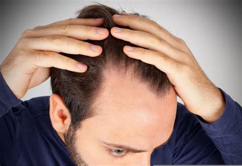 What Can Stop Male Pattern Baldness  Tips And Tricks