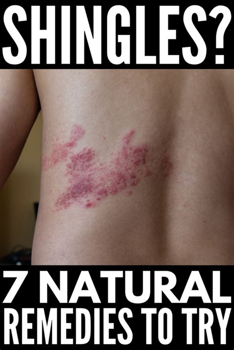 what can you do to treat shingles