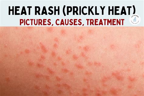 what cause heat rash