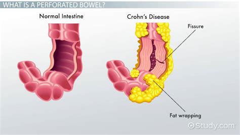 What Causes a Perforated Bowel: Critical Signs and Symptoms