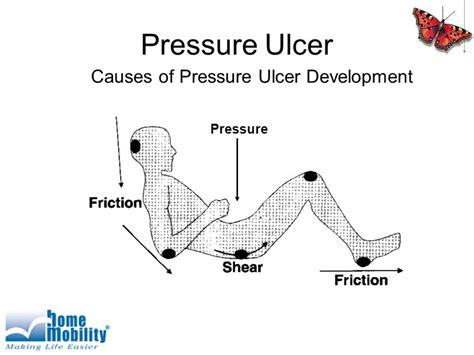 what causes a pressure sore