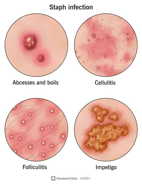 What Causes A Staph Boil