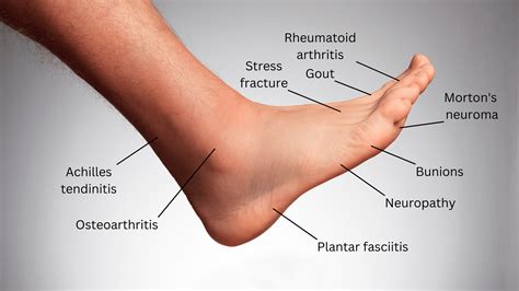 What Causes Ache Feet