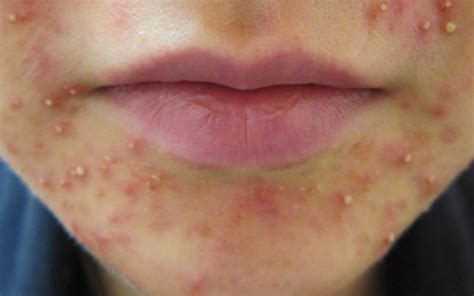 What Causes Acne Around the Mouth: Treatment and Prevention Tips