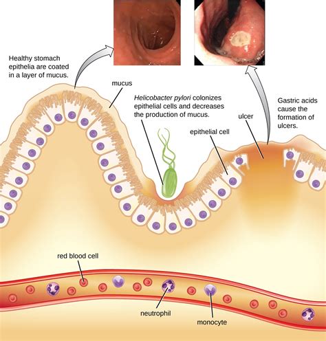 what causes bacteria in the stomach