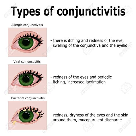 what causes bacterial conjunctivitis in the eye