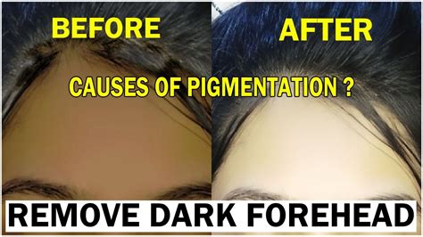 What Causes Black Forehead