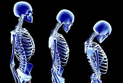 What Causes Bones To Bend