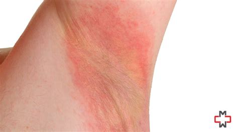 what causes contact dermatitis in armpits