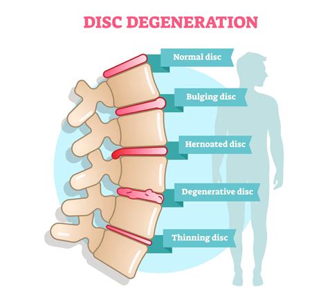 what causes degeneration of the spine