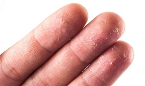 What Causes Dry Fingertips