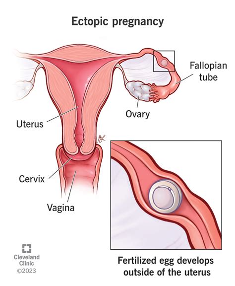 Understanding Ectopic Pregnancy: What Causes It and How to Identify the Risks