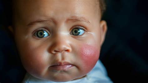 What Causes Flushed Face Without Fever