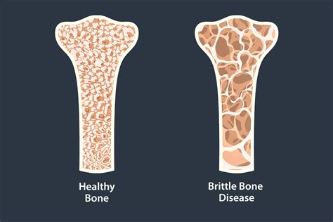 what causes fragile bones