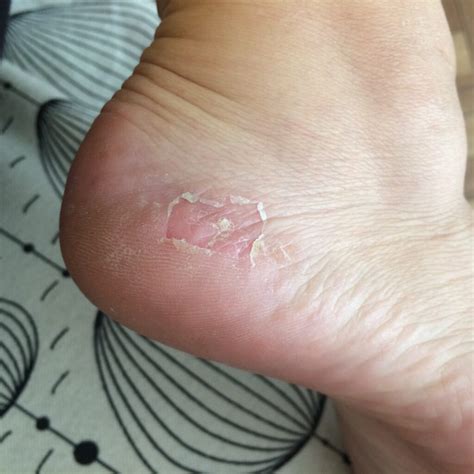 what causes itchy blisters on bottom of feet