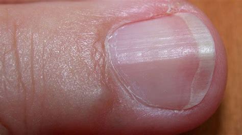 What Causes Jagged Fingernails