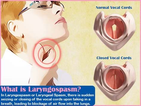 What Causes Laryngospasm