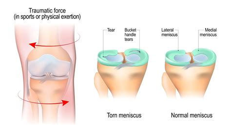 What Causes Locking Of Knee