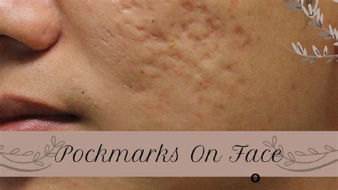 What Causes Pock Marks