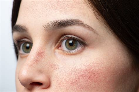 What Causes Red Flushed Cheeks