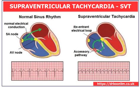 Understanding the Heart: What Causes SVT and How to Identify the Signs