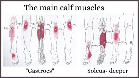what causes trigger points in calves