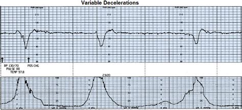 what causes variable decelerations in labor