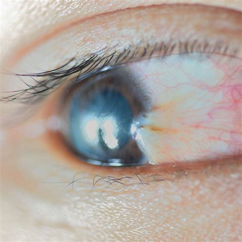 what causes white bumps on eyes