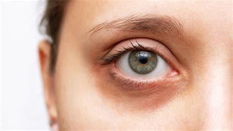 what causes white circles under eyes