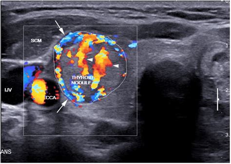 what color is thyroid cancer on ultrasound