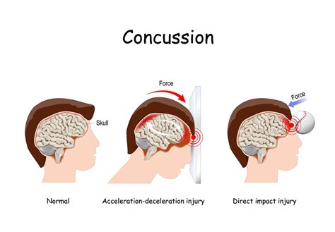 what damage does a concussion have