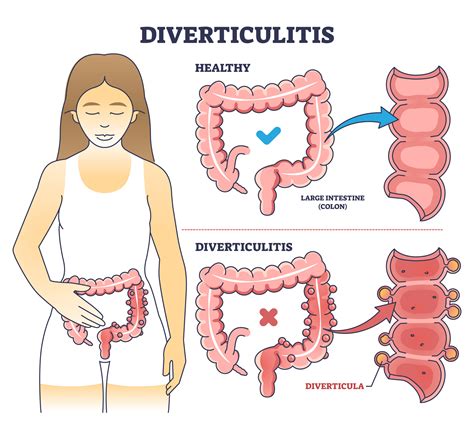 what damage does diverticulitis do to the body