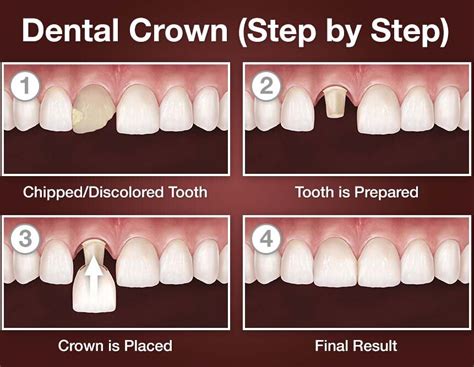 What Dentist Does Crown