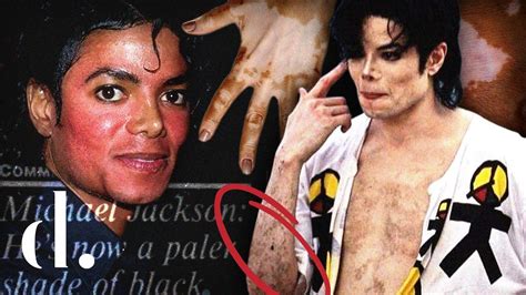 what diseases did michael jackson have