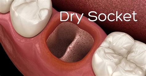 Dry socket and How long does Dry socket last CARDS DENTAL